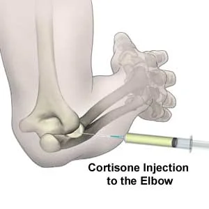 cortisone_injection.