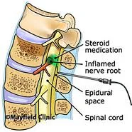 epidural